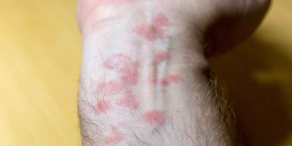 a man's arm with a rash caused by Rocky Mountain Spotted Fever