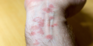 a man's harm with a rash caused by Rocky Mountain Spotted Fever